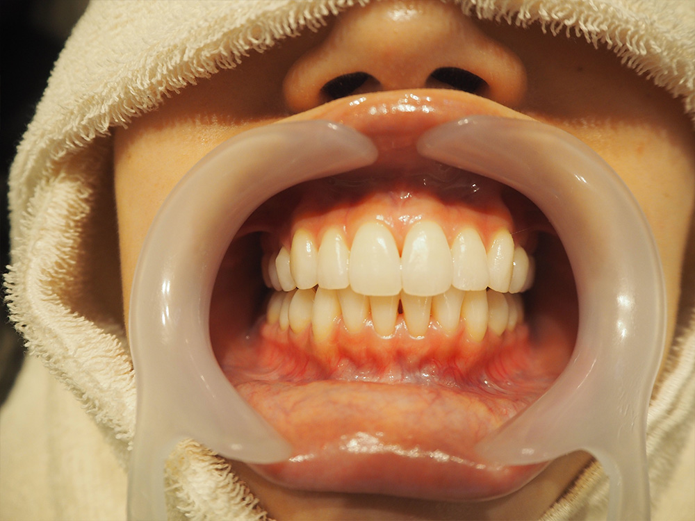 後新しい歯茎の粘膜に生まれ変わります
