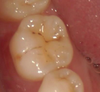 歯に黒い点があるのですが 歯の点の正体は 初期虫歯って何 よしだ歯科スタッフブログ