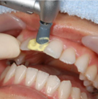歯周病治療（THP）
